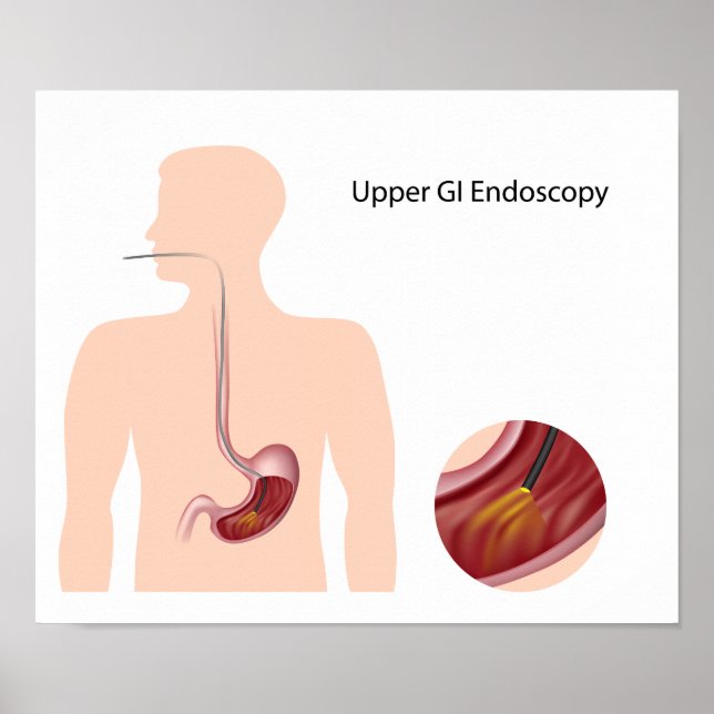 Poster de l'endoscopie IG supérieur (Devant)