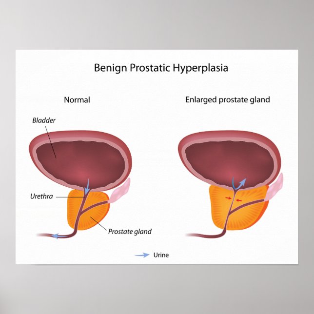 Poster de l'hyperplasie prostatique bénigne (Devant)