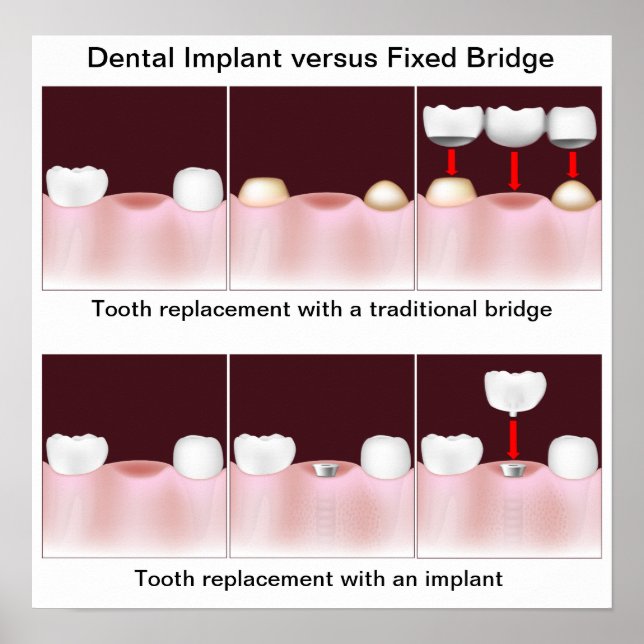 Poster de l'implant dentaire contre le pont (Devant)