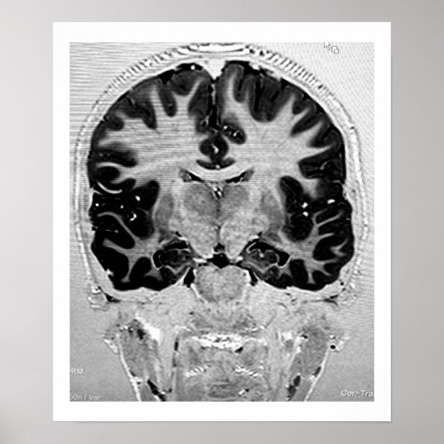 Poster de tête IRM (Devant)