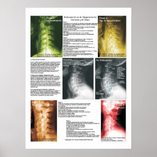 Poster Dégénérescence spinale cervicale de subluxation