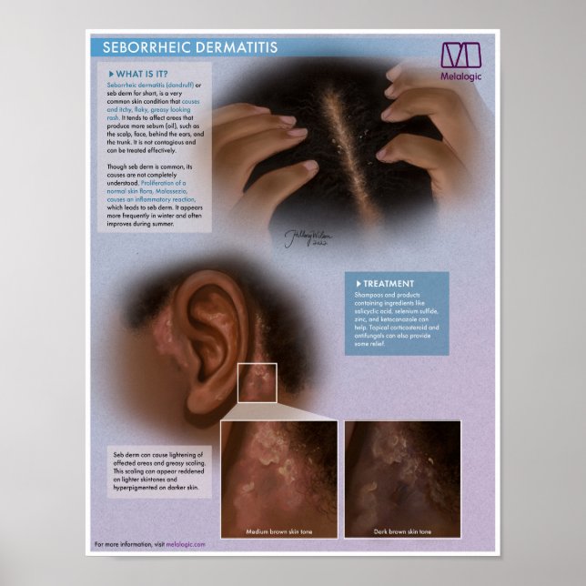 Poster Dermatite séborrhéique (Dandruff) Médicale (Devant)