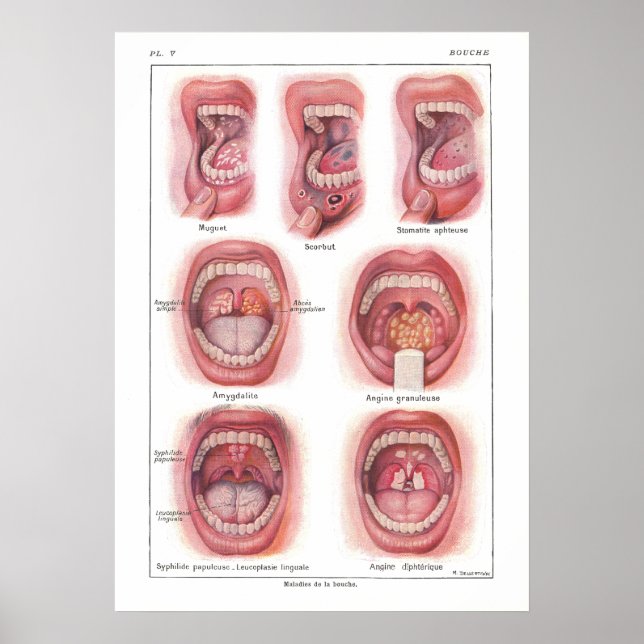 Poster des maladies de la bouche Anatomie Français (Devant)