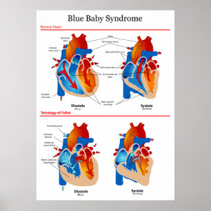 Poster Diagramme anatomique de coeur de syndrome de béb