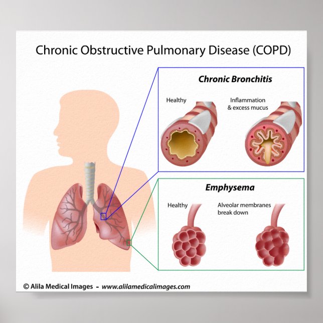 Poster Diagramme de maladies pulmonaires (Devant)