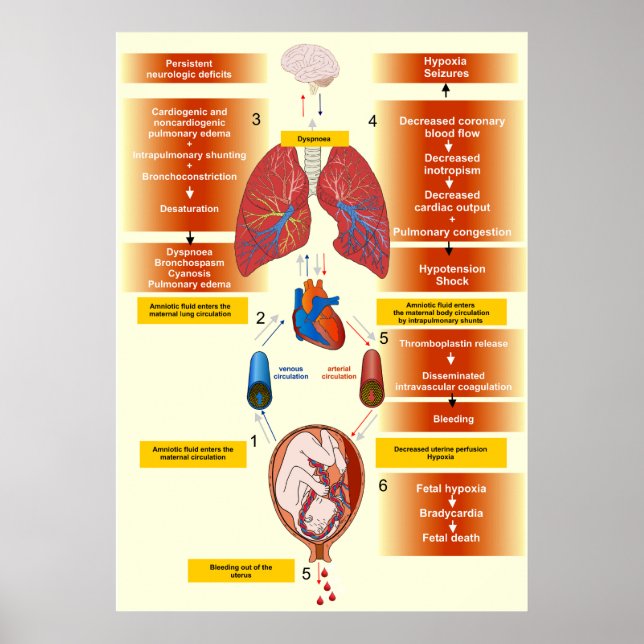 Poster Diagramme d'un embolisme amniotique de fluides (Devant)