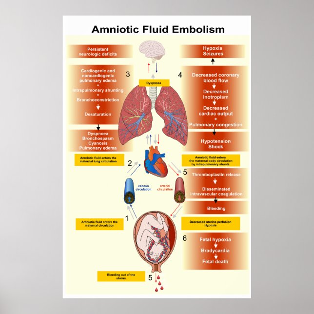 Poster Diagramme d'un embolisme amniotique de fluides AFE (Devant)
