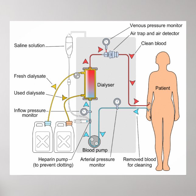 Poster Diagramme d'un traitement Médicale d'hémodialyse (Devant)