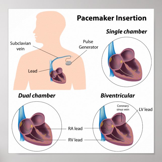 Poster d'insertion Pacemaker (Devant)