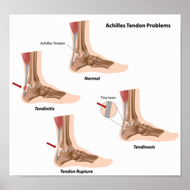 Poster Douleur de pied Achilles problèmes de tendon Poste (Devant)
