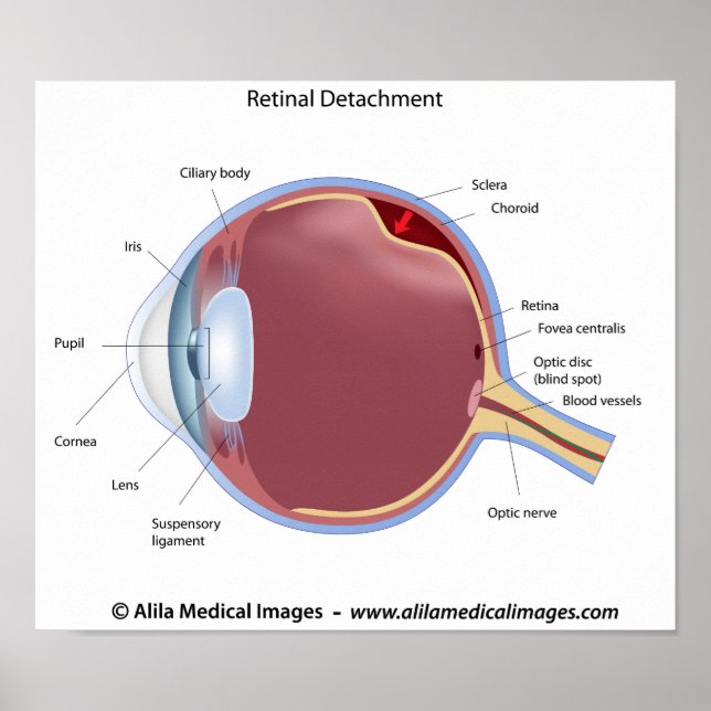 Poster du détachement rétinien des yeux (Devant)