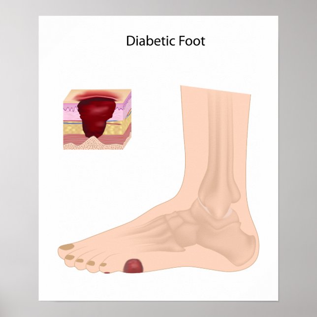 Poster du pied diabétique (Devant)