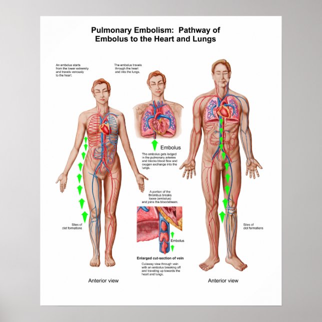 Poster Embolisme Pulmonaire, Voie D'Embolus (Devant)