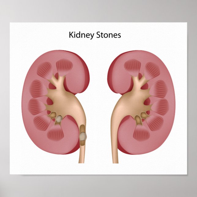 Poster en pierre de Kidney (Devant)