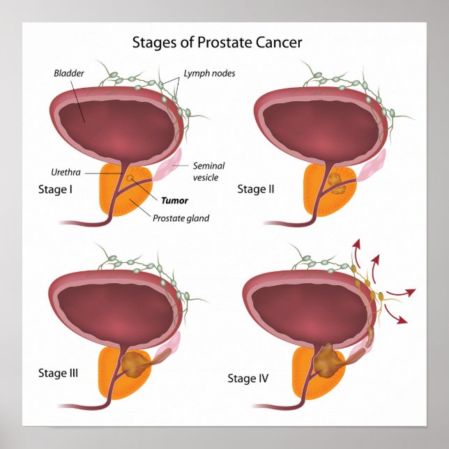 Poster Étapes du cancer de la prostate (Devant)