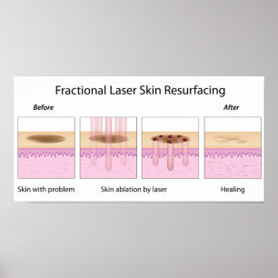 Poster Fractionnel Refaçonnant la peau au laser