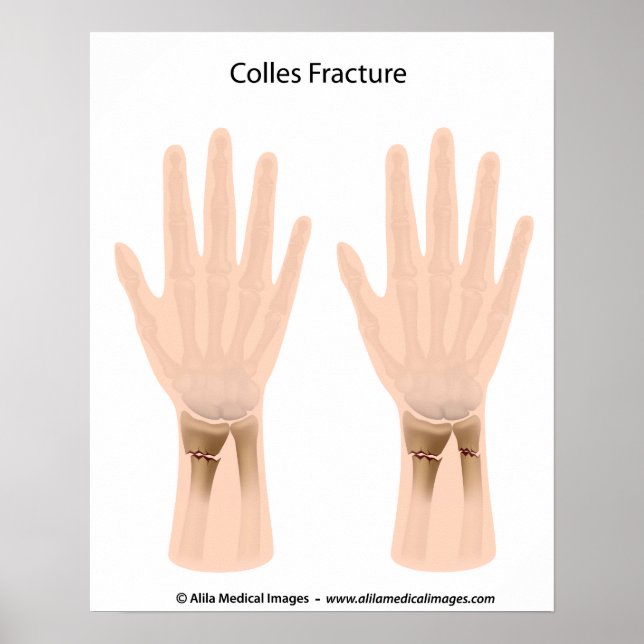 Poster Fracture de colles, illustration médicale. (Devant)