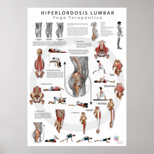 Poster Hiperlordosis - définition, causes et traitement (Devant)