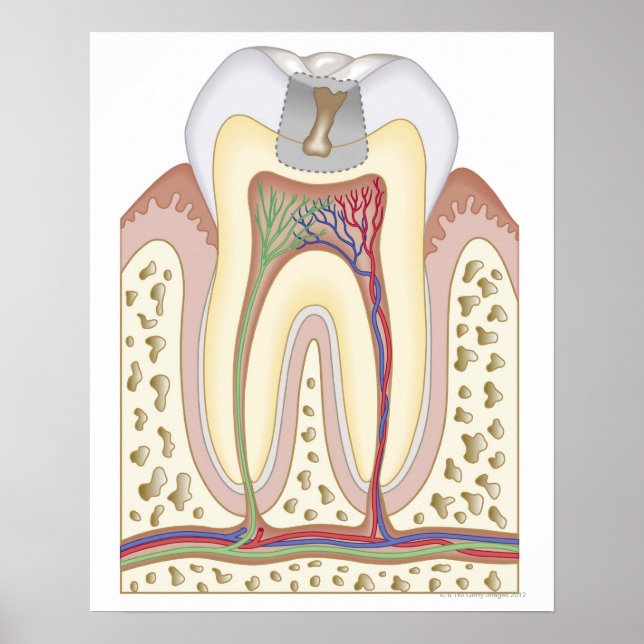 Poster Illustration de la carie dentaire (Devant)