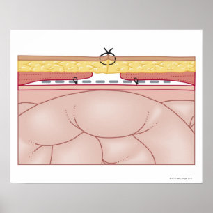 Poster Illustration d'une hernie