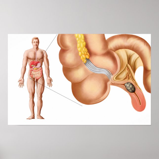 Poster Illustration Médicale D'Un Appendice (Devant)