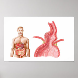 Poster Illustration Médicale D'Une Hernie Hiatal Dans