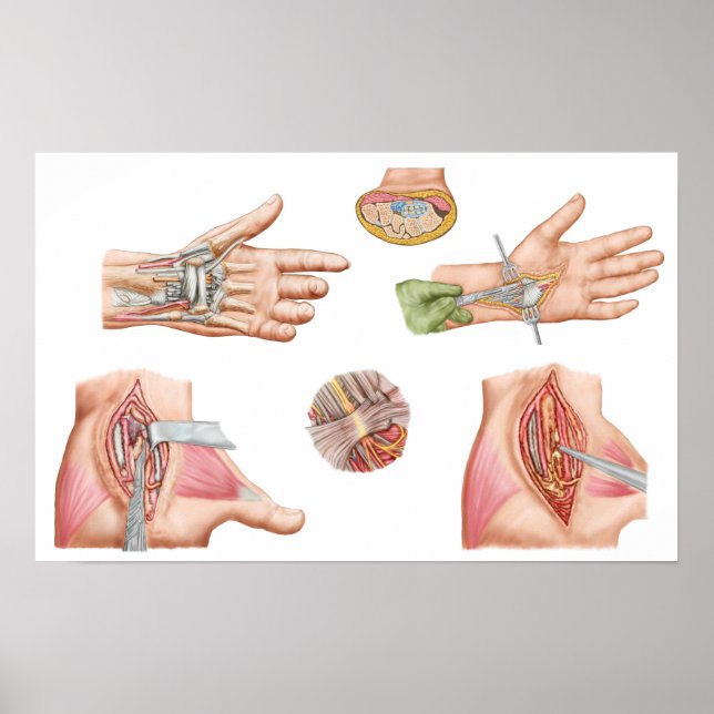 Poster Illustration Médicale montrant le tunnel carpal (Devant)