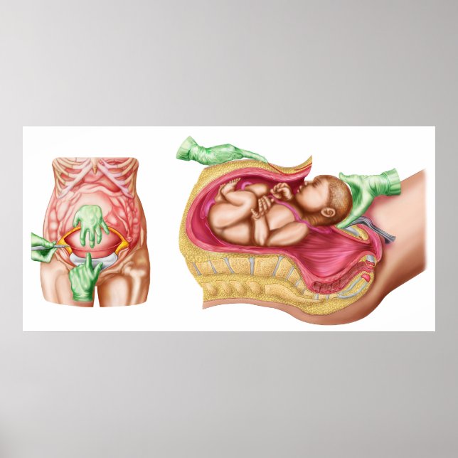 Poster Illustration Montrant La Livraison Cesarienne Du F (Devant)