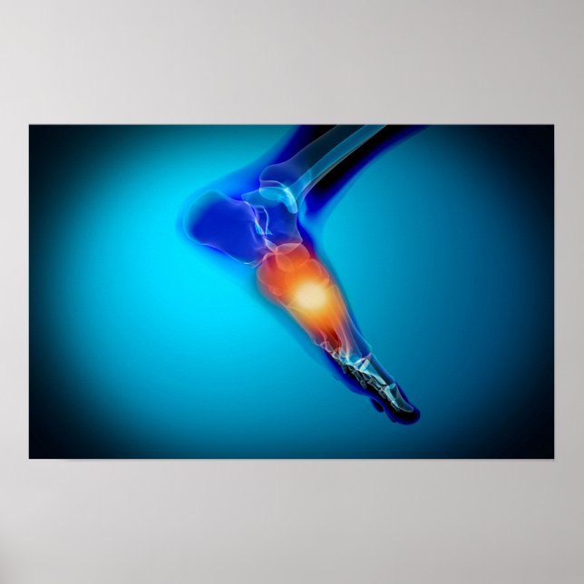 Poster Image Conceptuelle De La Douleur Dans Le Pied Huma (Devant)