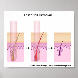 Poster Laser hair removal procedure
