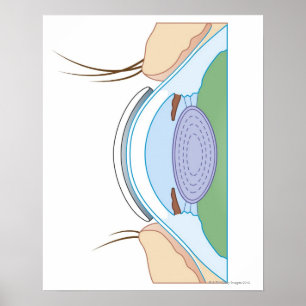 Poster Lentille de contact souple