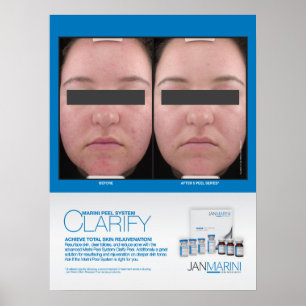 Poster Marini Peel Clarify Résultats 18x24"