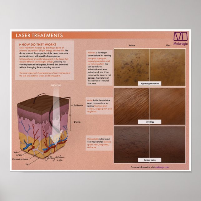 Poster Médicale de traitement Laser Melalogique (Devant)