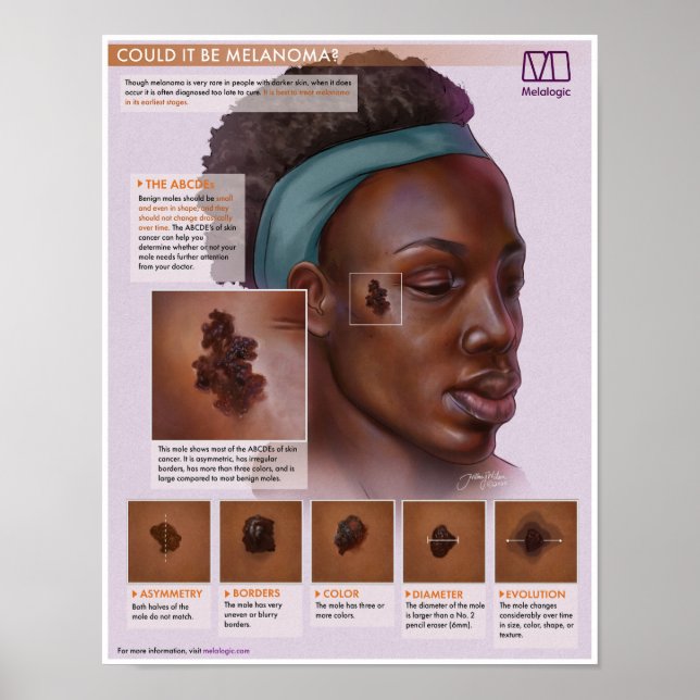 Poster Melanoma Melaloga Médicale (Devant)