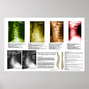 Poster Phases Espagnoles Cervical Spinal Degeneration Pos
