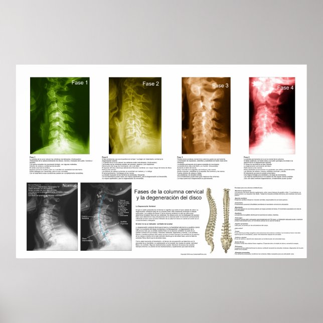 Poster Phases Espagnoles Cervical Spinal Degeneration Pos (Devant)