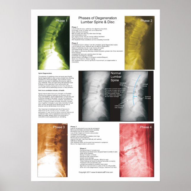 Poster Phases Lombaire Dégénération de la colonne vertébr (Devant)