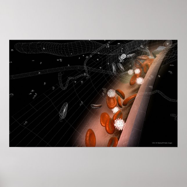 Poster Plaque dans les artères (Devant)