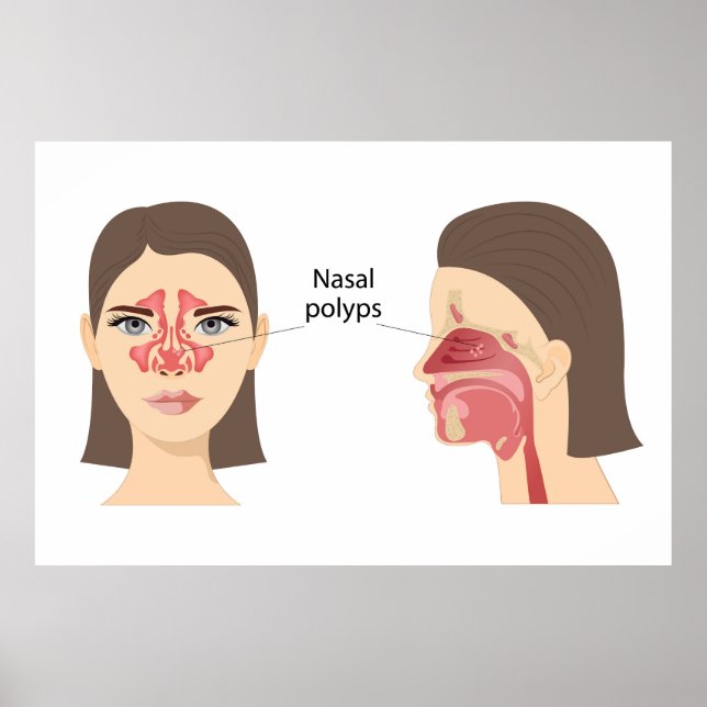 Poster polypes nasaux (Devant)