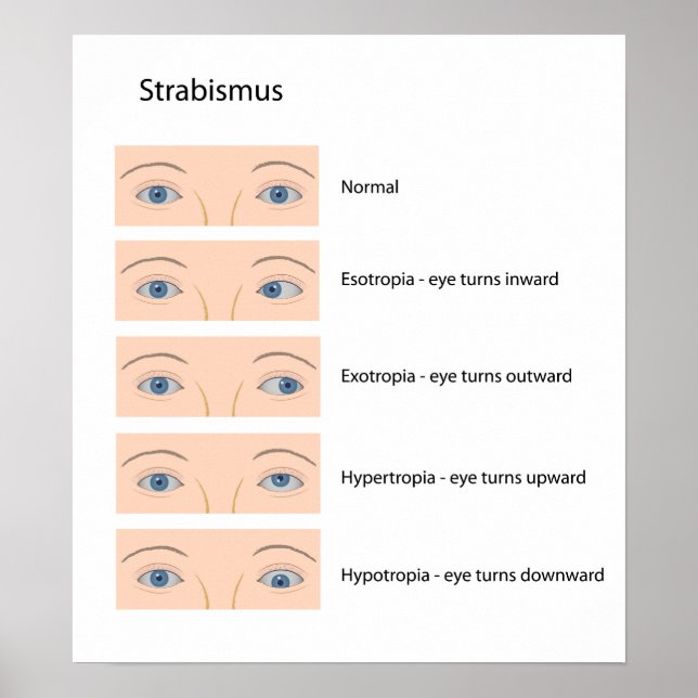 Poster pour défaut oculaire Strabismus (Devant)