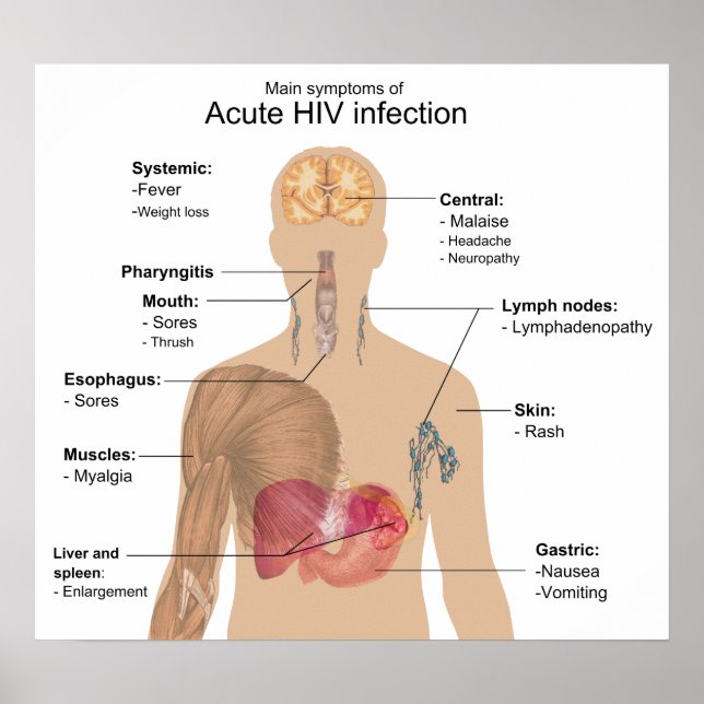Poster Principaux symptômes de l'infection aiguë par le V (Devant)