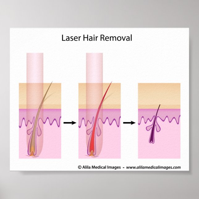 Poster Procédure d'enlèvement des cheveux laser (Devant)