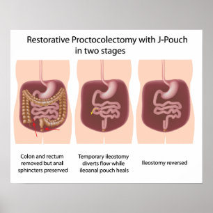 Poster Proctocolectomie réparatrice avec j-pouch 2 étapes