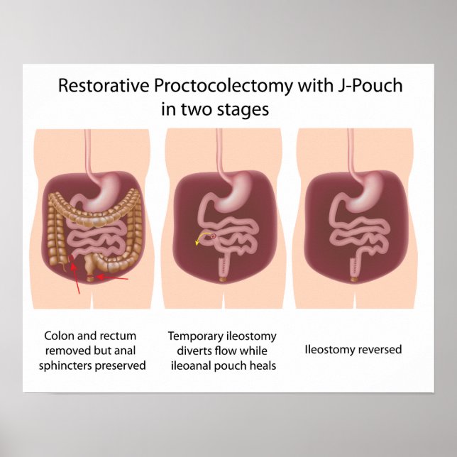 Poster Proctocolectomie réparatrice avec j-pouch 2 étapes (Devant)
