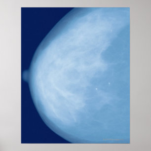 Poster Rayon X du sein féminin, vue latérale