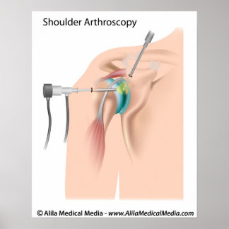 Poster Schéma d'arthroscopie de l'épaule.