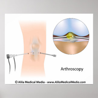 Poster Schéma d'arthroscopie du genou.