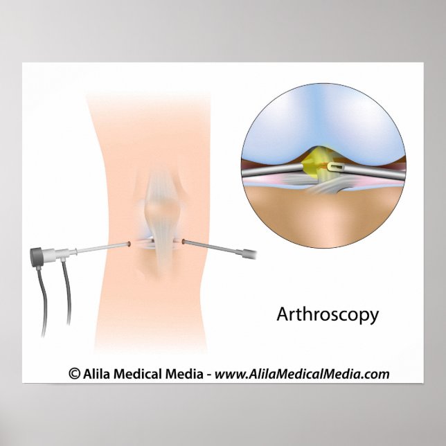 Poster Schéma d'arthroscopie du genou. (Devant)