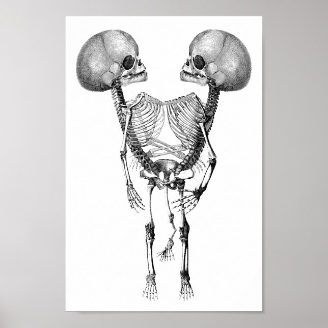 Poster Siamese joint Twins Anatomy Skeletons art (Devant)
