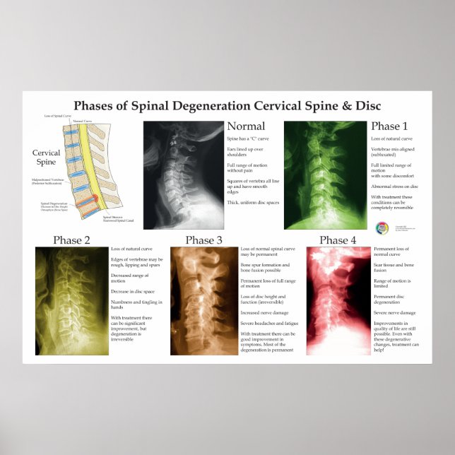 Poster Spinal Degeneration Cervical Spine Chiropractic (Devant)